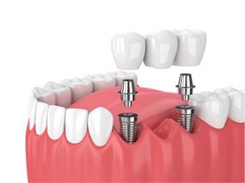 Is A Dental Bridge A Suitable Solution For Tooth Replacement?
