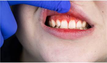 What Are The Risk Factors Of Gum Disease?